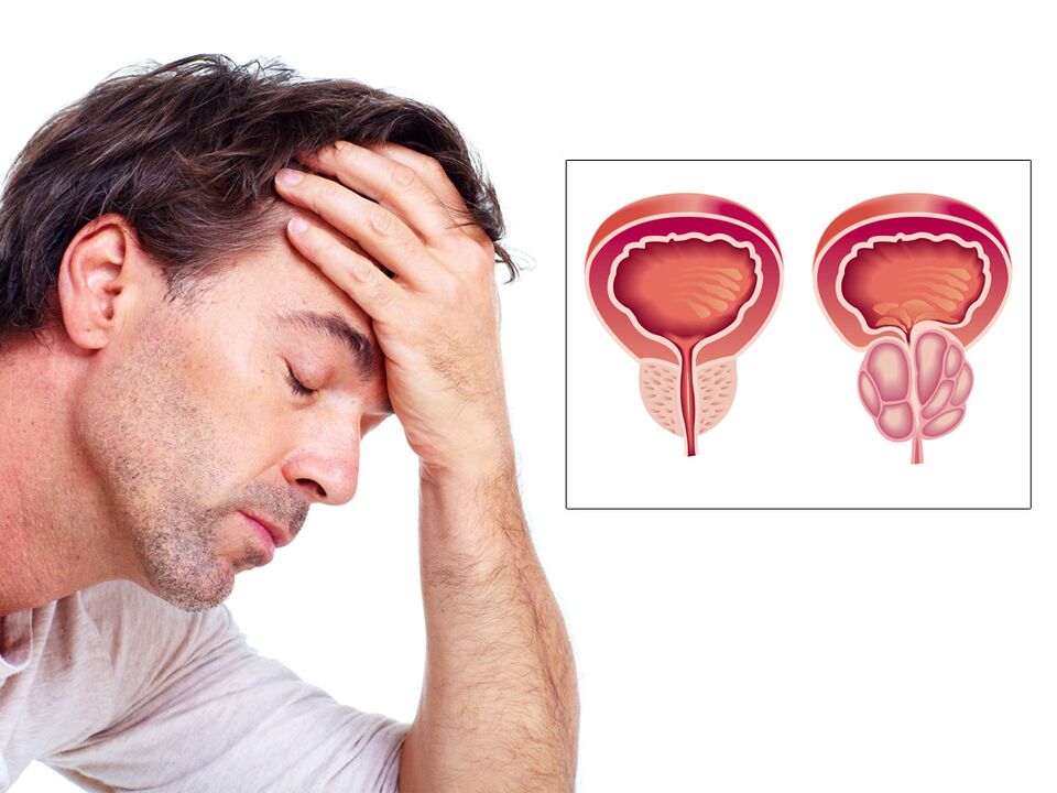 adenóm prostaty s impotenciou